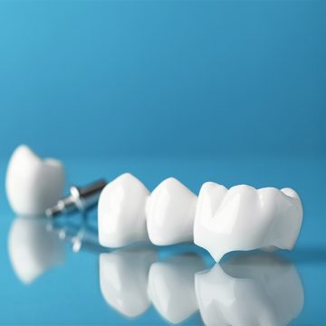 Does Your Dental Insurance Cover Crowns? Here’s What You Need to Know