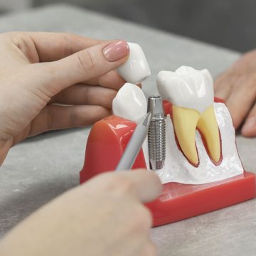 How Dental Implants and Bridges Can Replace Missing Teeth in St. Catharines