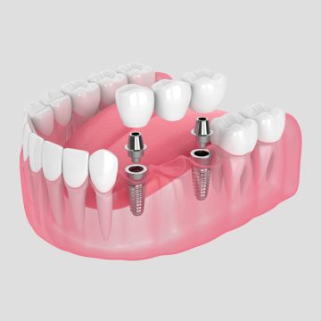 Dental Implants and Crowns in St. Catharines: Implants Starting at $2,500