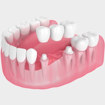 Cost & Procedure Guide for Dental Bridges and Dental Implants in St. Catharines